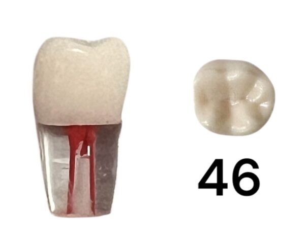 Endo Tooth 46