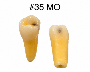 Caries Teeth 35 Mo Connected