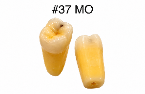 Caries Teeth 37 MO Connected
