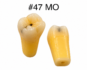 Caries Teeth 47 MO Connected